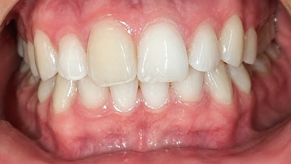 Antes del tratamiento Invisalign: problemas de alineación dental